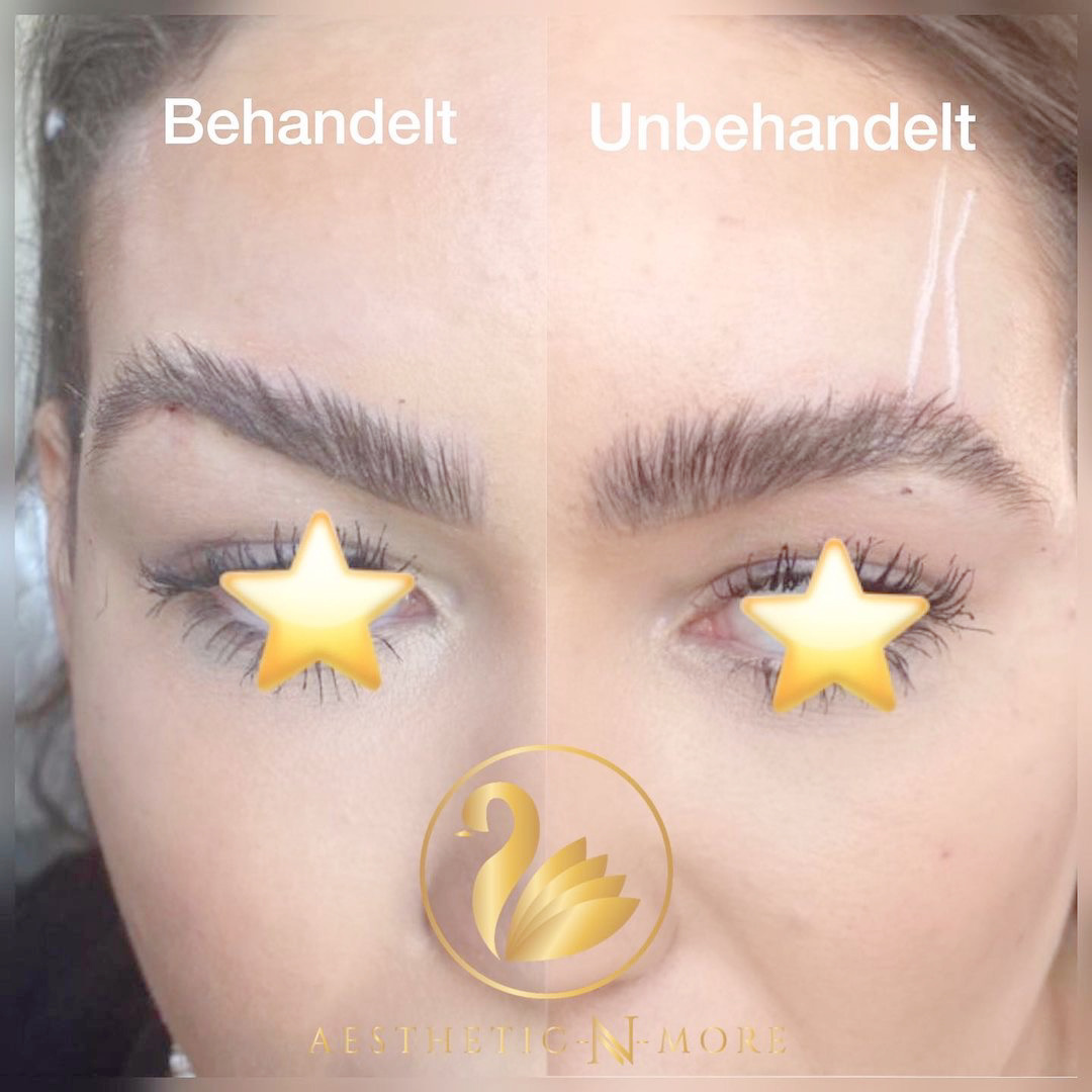 Browlift mit Fäden